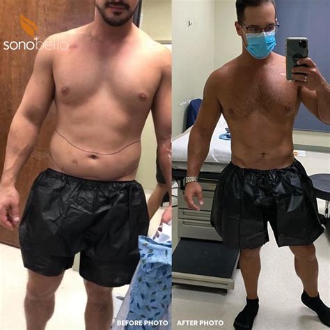 Reach Your Body Goals In Just One Visit 1. When it comes to your health and happiness, you deserve the best. Sono Bello ® is America’s top cosmetic surgery specialist*, with 185+ board-certified surgeons who have performed over 300,000 laser lipo & body contouring procedures. 
